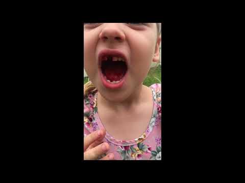 Kora's front tooth removal