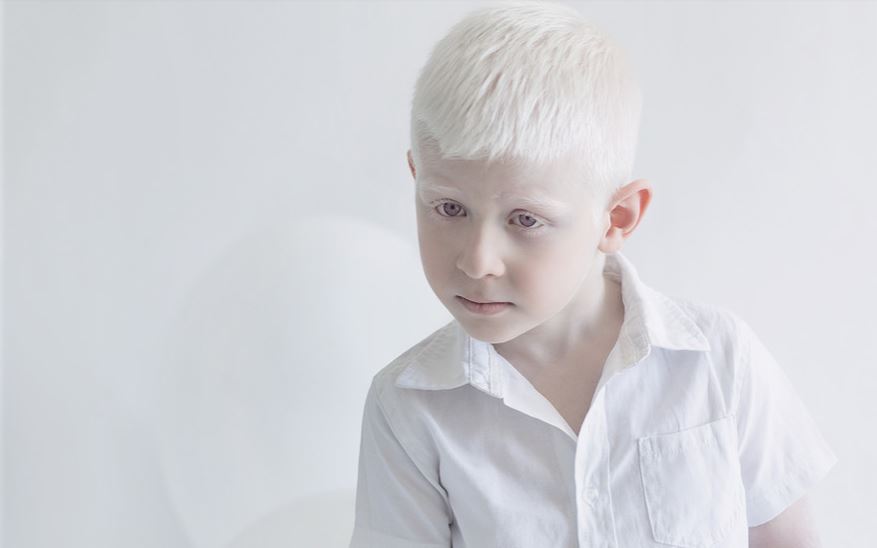 красоты альбиносов