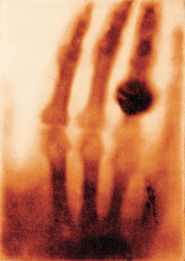 The Hand of Mrs. Wilhelm Röntgen